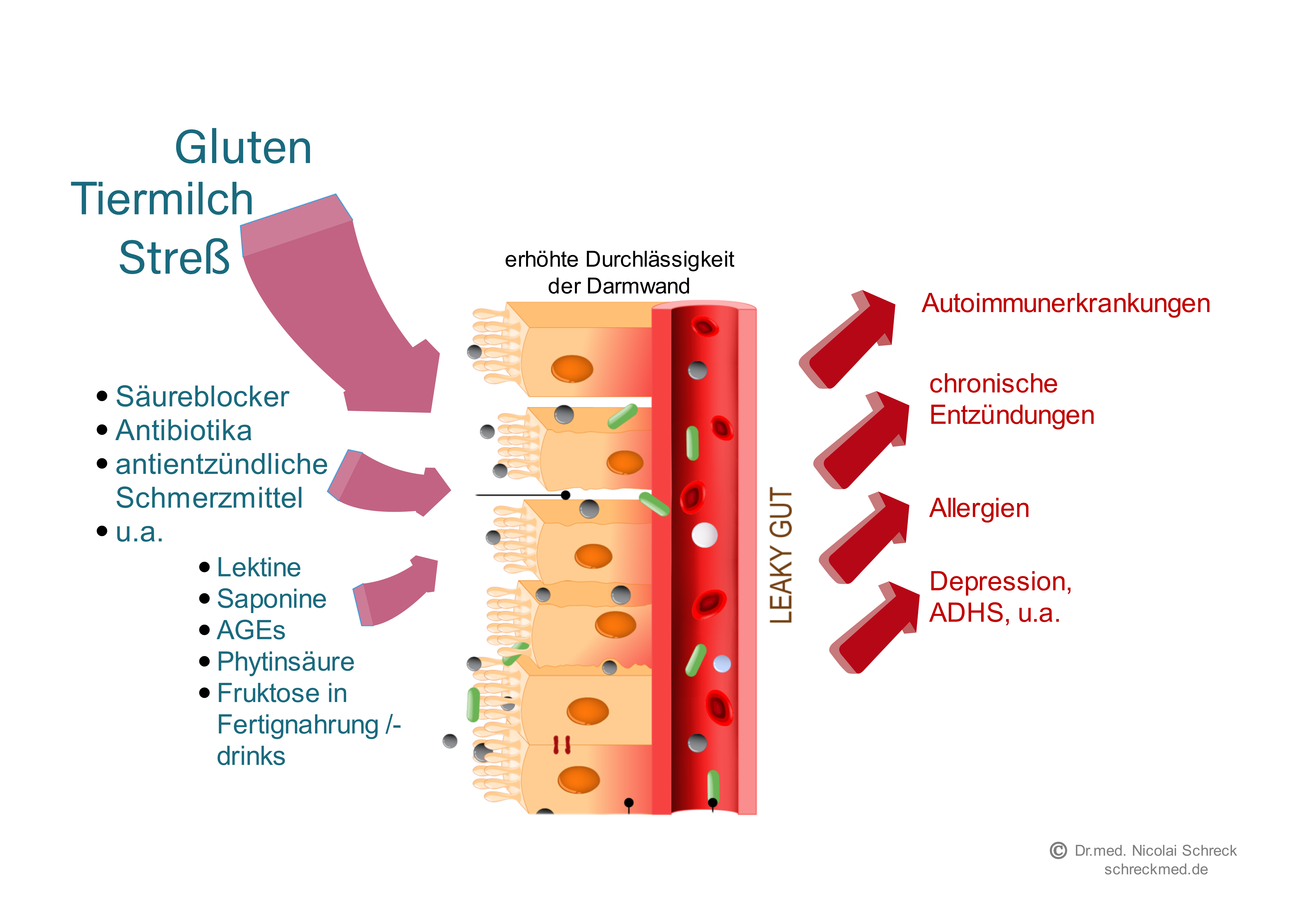 leaky-gut-Ilustration